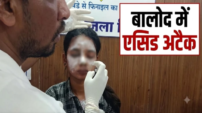 लाइब्रेरी से लौट रही युवती पर एसिड अटैक, सिंचाई कॉलोनी की घटना, हमलावर का सुराग नहीं